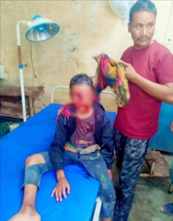 चमोली: भालू के हमले में 10 वर्षीय बालक गंभीर रूप से घायल, चेहरे पर गहरे जख्म और हाथ फ्रैक्चर